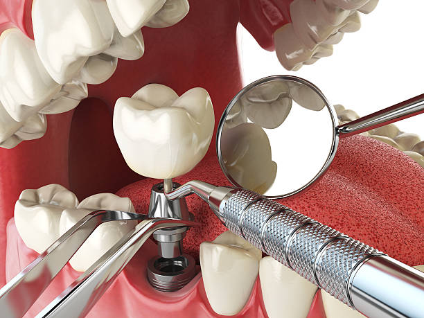 Best Broken or Cracked Tooth Emergency Dentist in Churubusco, IN