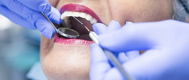 Best Emergency Dentist for Lost Fillings or Crowns in Churubusco, IN